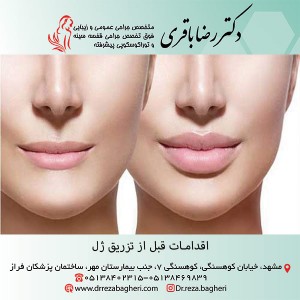 اقدامات قبل از تزریق ژل